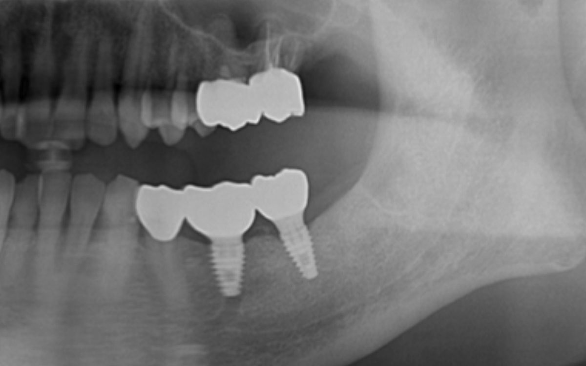 上部構造装着後のX線写真。インプラントを支える骨の状態を確認できる